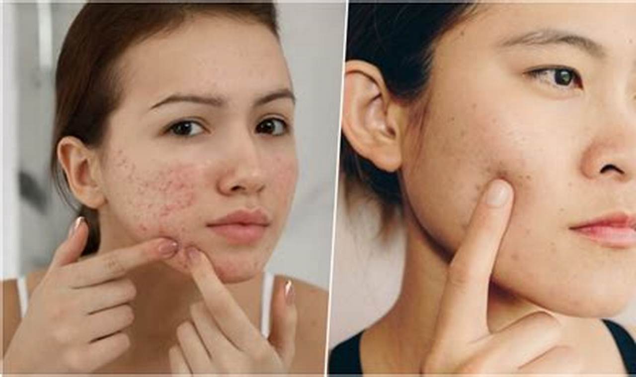cara mengatasi bekas jerawat merah